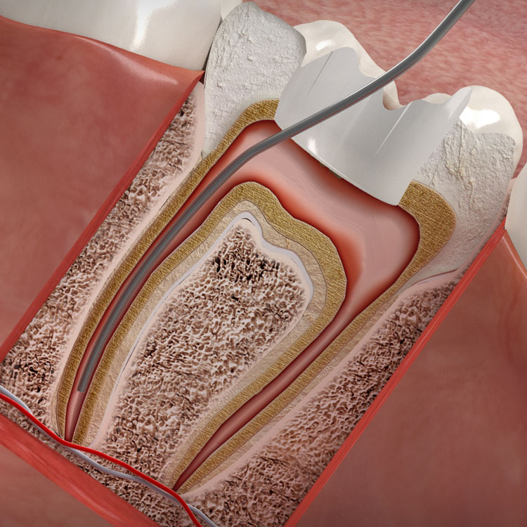 Wurzelkanalbehandlung (Endodontie)